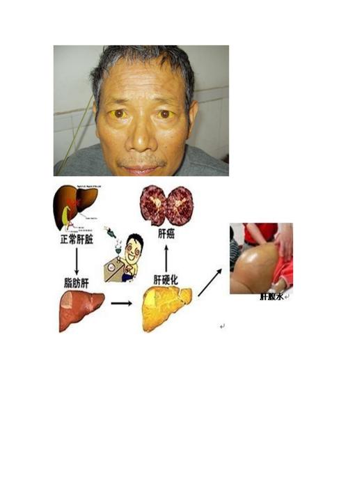 护士肝硬化患者的识别 第1张